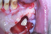 oral cyst removal