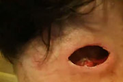 Cyst Removed