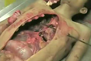 Full Autopsy Video