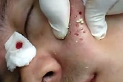 Holes Drilled In Acne Face