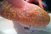 Dry Cheesy Foot Skin