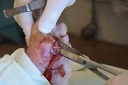 Horrific Cyst Removal From A Foot