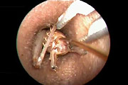Live Insect Inside Man's Ear