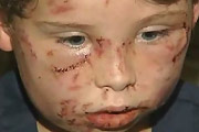 Boy Attacked By Pitbull