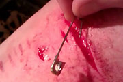 Needle Cutting In Leg