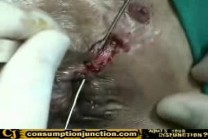 hemroid operation