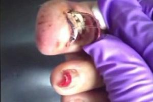 Maggots living Under toenail
