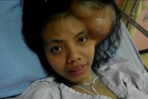 Pretty Young Girl with Huge Tumor
