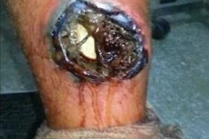 Maggot Infested Wound