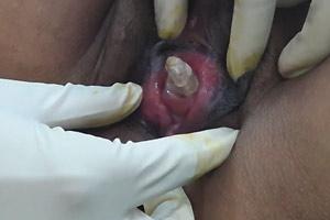 Pussy Stone Removal