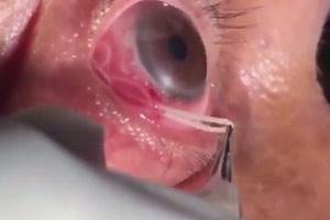 Parasitic Worm Removed From Mans Eye