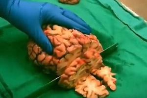 Slicing Human Brain