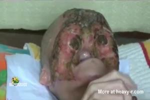 Face Eaten Away By Cancer