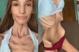 Extreme Anorexic Show Off