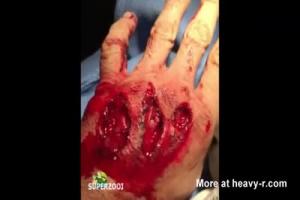 Horrific Hand Injury