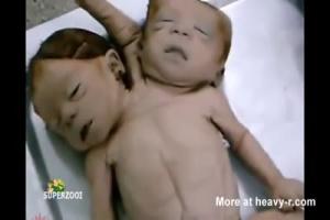 Dead Deformed Baby Bodies