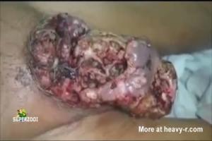 Whats Left Of A Mans Maggot Infested Penis